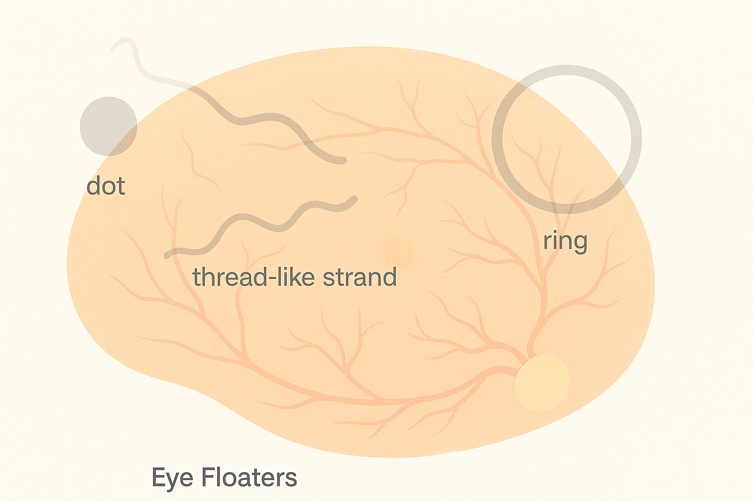 Illustration showing common shapes of eye floaters over a normal retina