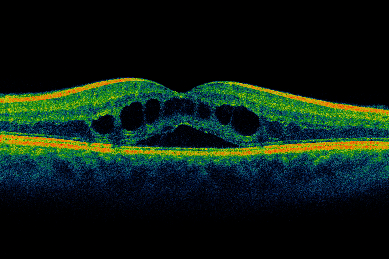 OCT scan showing cystoid spaces within the macula